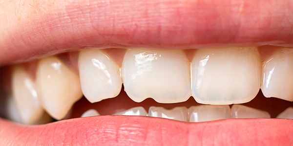 外傷歯の歯冠破折症例